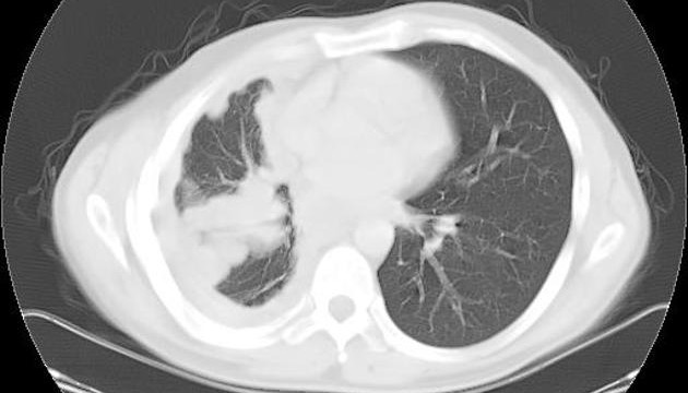 Lotta al mesotelioma pleurico:insieme contro l’amianto